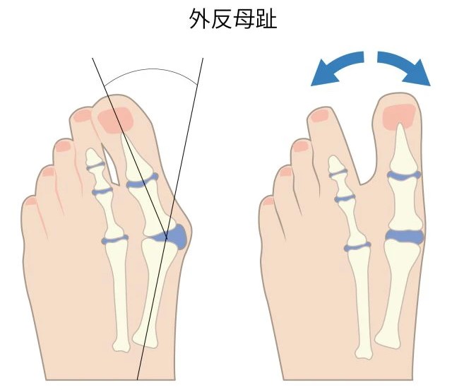 外反母趾原因